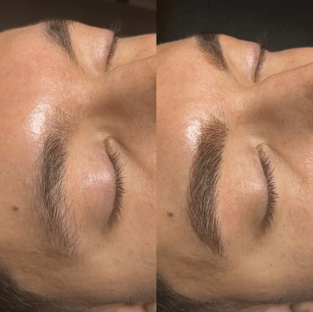 MIDAS #18U Ultra Nano 0.16mm Microblading Needle - MICROBLADING - MEI-CHA