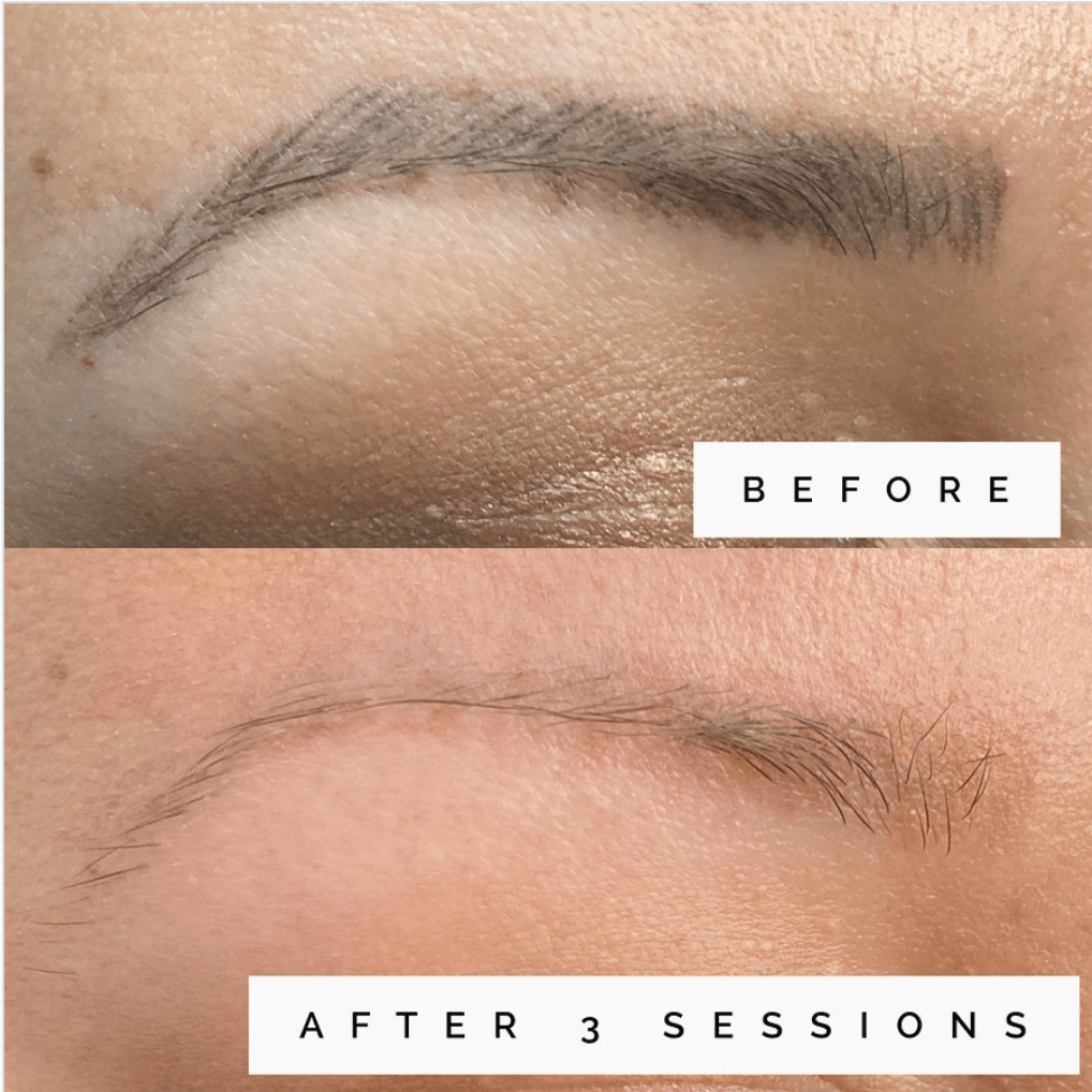 Saline Tattoo Removal: The Good, The Alternative and What All PMU Artists Should Know by Emily Fabrocini - MEI-CHA -  